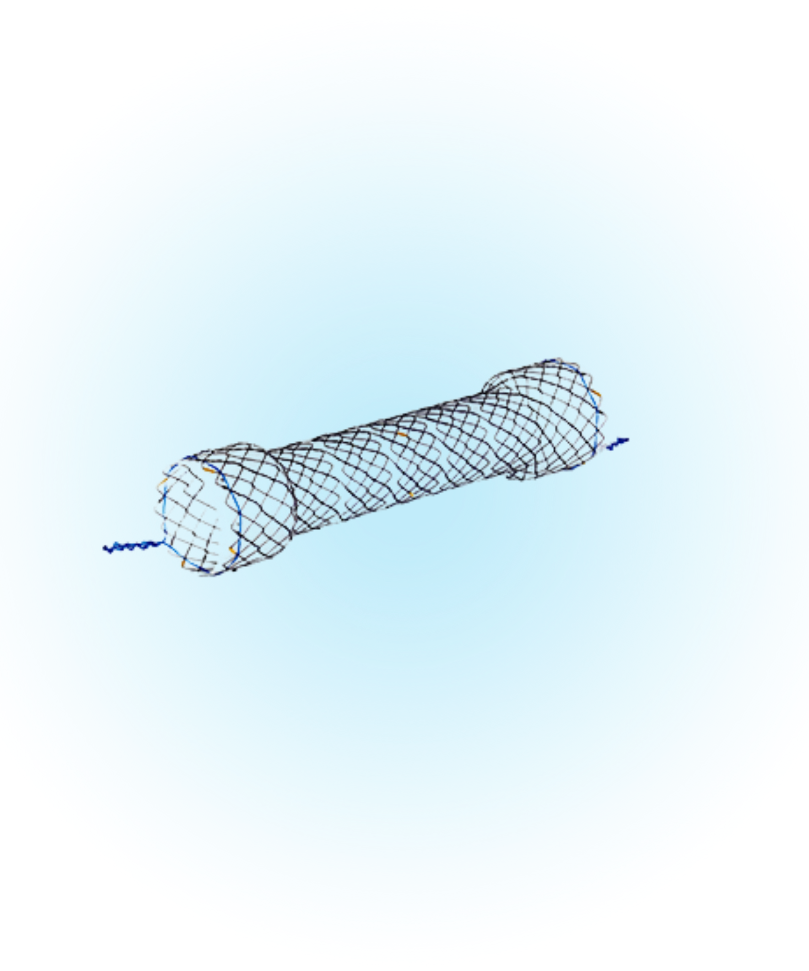 Özefagus Metal Stent