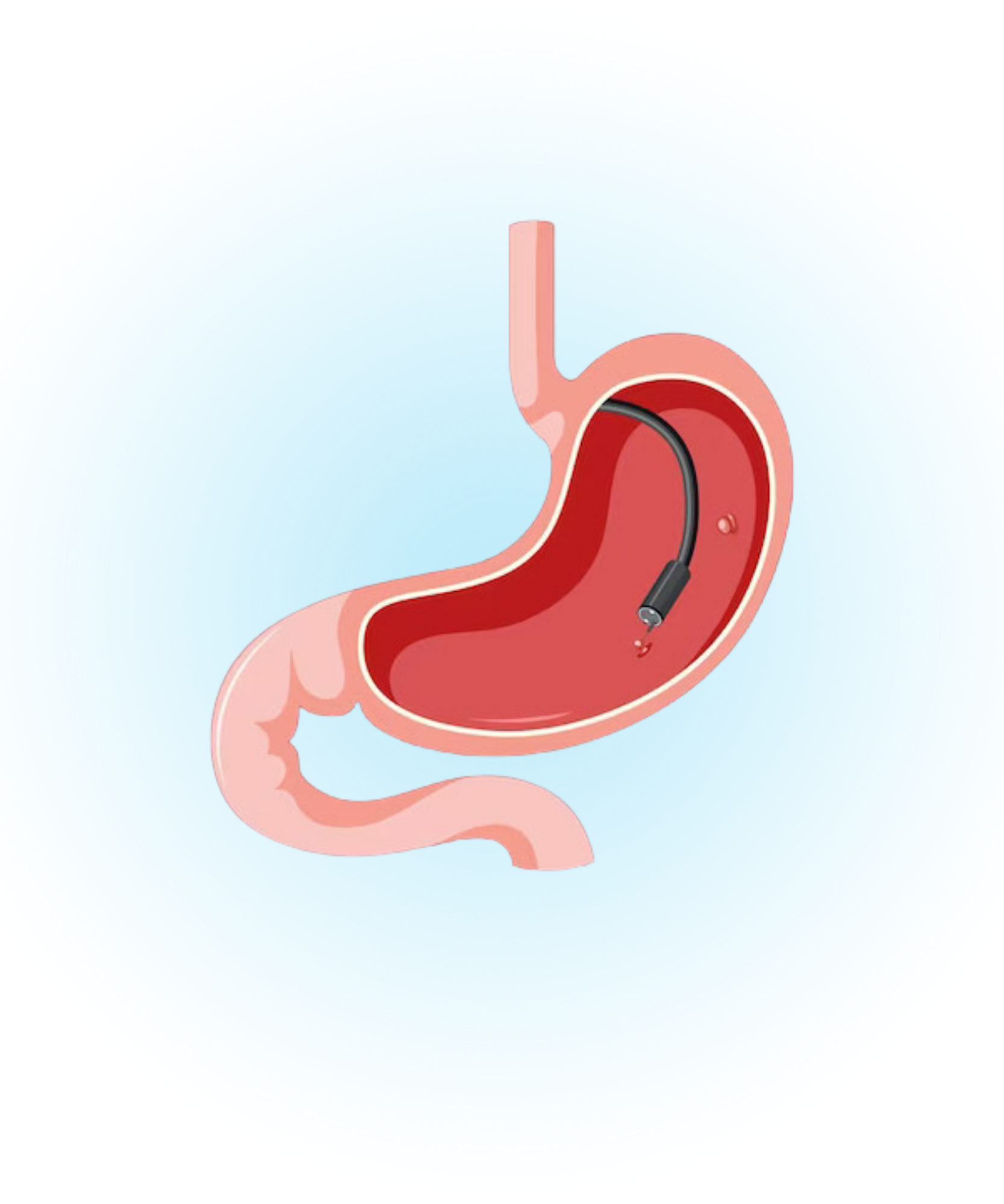 ERCP