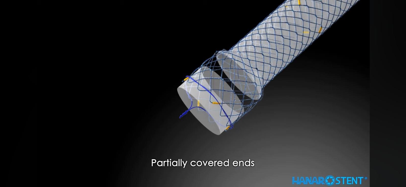 Kaplı Nonvasküler Metal Stent