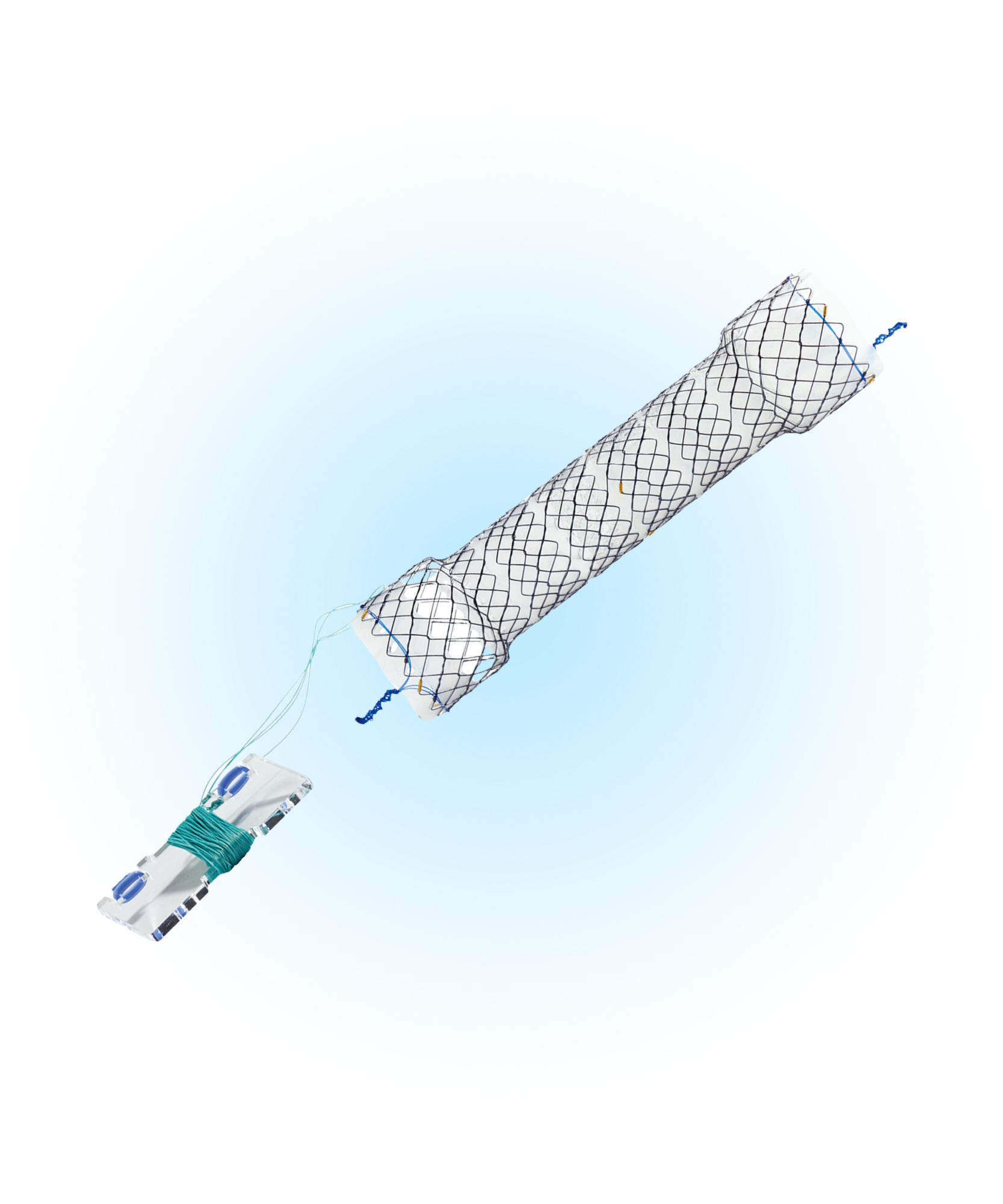 HEVT Özefagus Yarı Kaplı Peristaltik Uyumlu Anti-Reflü Valfli İpli Stent